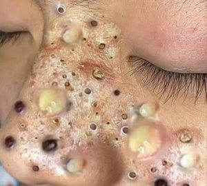 Treating Shingles on the Scalp