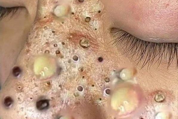 Treating Shingles on the Scalp...Read More in Comments👇