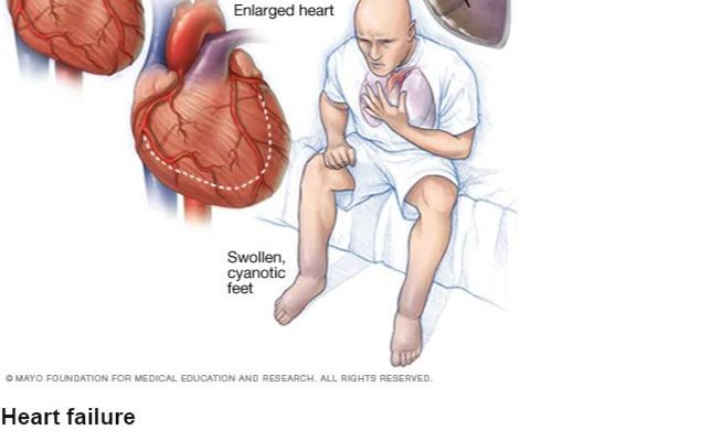 The Subtle Symptom Of Deadly Heart Failure You Might Spot In Bed