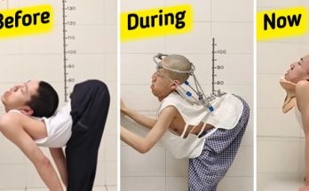 A Teen Who’s Called “Folded Boy” Took a Step Closer to Stand Up Straight Again After a High-Risk Surgery