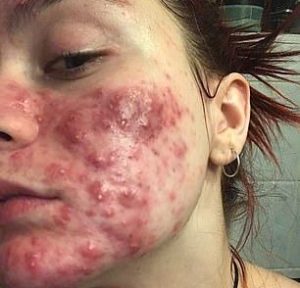 What is perioral dermatitis and how is it treated?