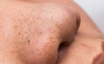 Blackheads: Causes, Symptoms, and Treatments