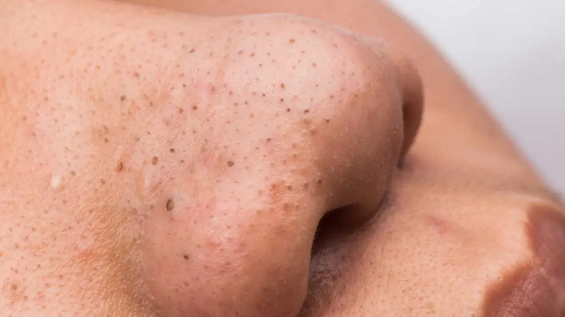 Blackheads: Causes, Symptoms, and Treatments