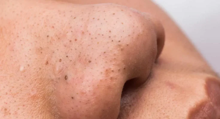 Get Rid of Blackheads: 4 Proven Ways (Plus How to Remove with VIDEO)