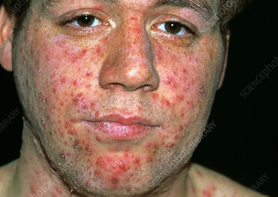 Blisters on the face can have many causes, including: