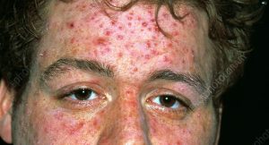 Blisters on the face can have many causes, including: