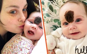 Parents Hid Baby's Face to Shield Her from Stares — Now, at 2, She Looks 'Gorgeous' After Surgery