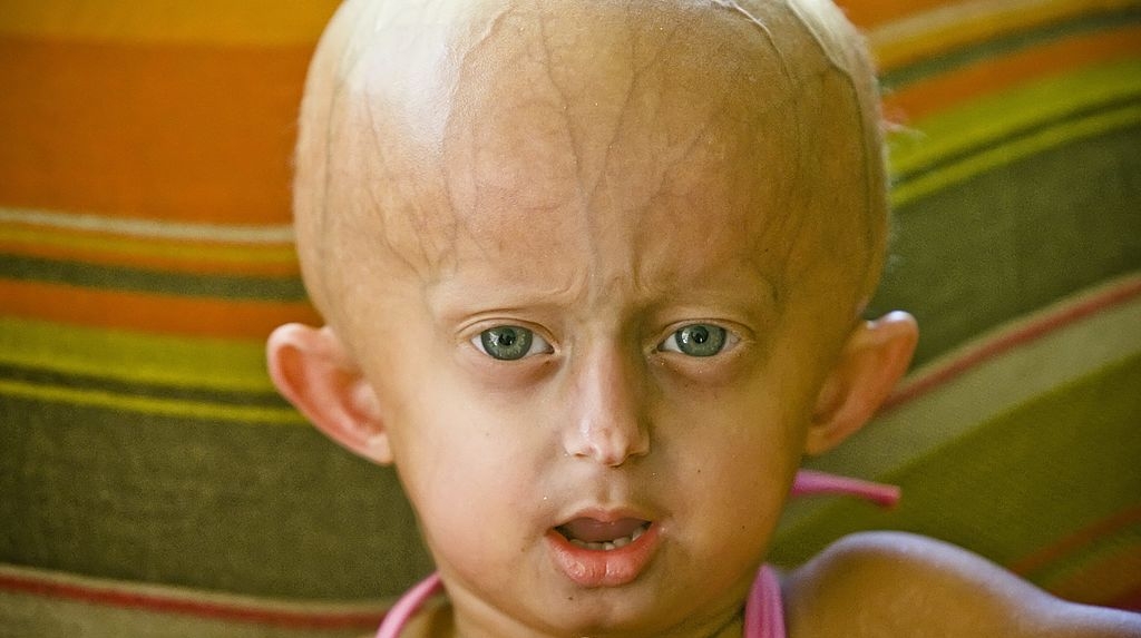 TikTok star Beandri Booysen dies at 19 from rare aging disease