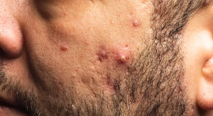 How to Treat Hormonal Acne and Use Natural Remedies