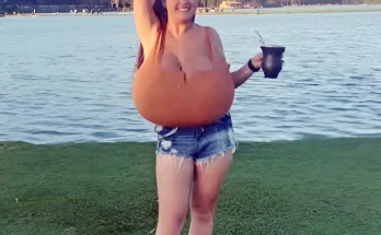 Girl with Gigantomastia Undergoes Surgery, Loses 10kg (22lbs): Positive Story of the Day