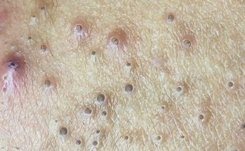 What are blackheads?