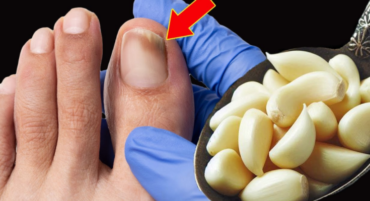 The Ultimate Nail Fungus Killer: A Natural Remedy That Works Fast
