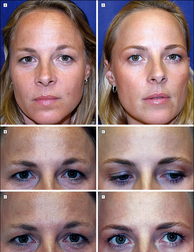 Identical twins reveal surprising results after one used botox for 20 years while the other didn't
