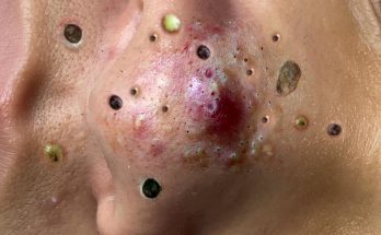 25 Causes of Raised Skin Bumps ( Pictures & Videos)