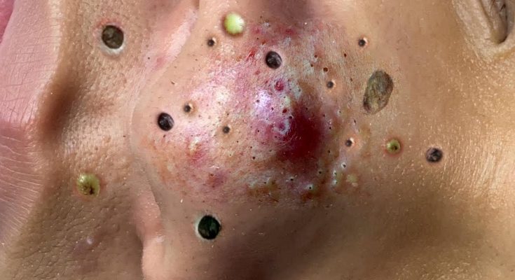 25 Causes of Raised Skin Bumps ( Pictures & Videos)