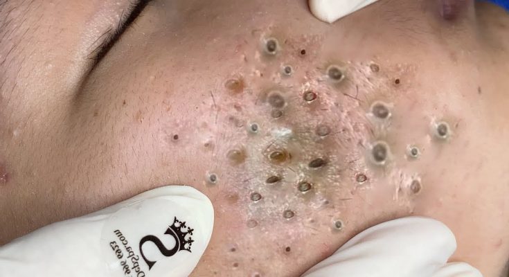 How to Get Rid of Blackheads