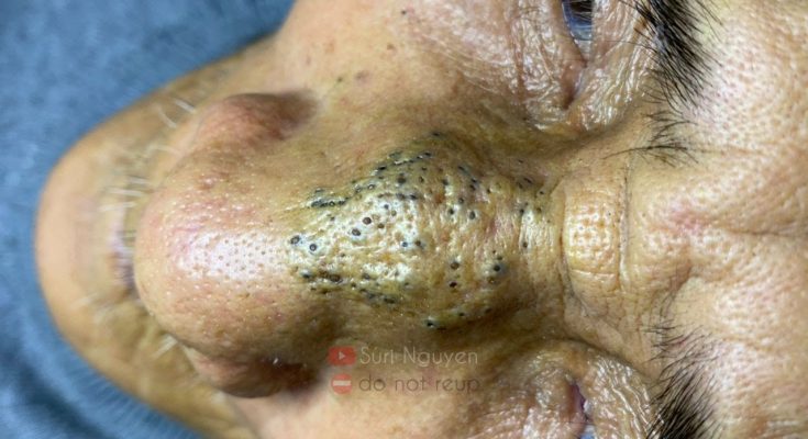 How Many Different Kinds of Facial Blemishes Are There?