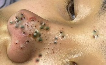 Whiteheads vs. Blackheads: Causes, Treatments, and Tips (Video)