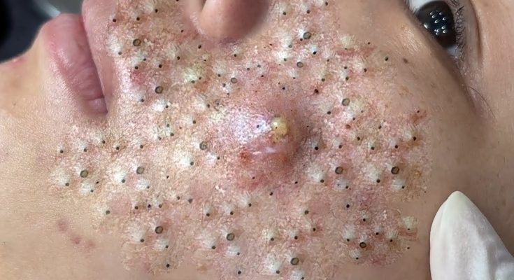 Whiteheads vs. Blackheads: Causes, Tips, and More