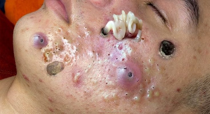 20 Ways to Treat and Prevent Deep Blackheads