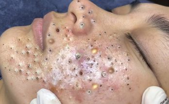 Adult Acne: I’m a Decade Past Puberty — Why Am I Still Breaking Out?