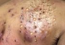 What can cause raised skin bumps?