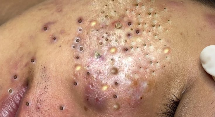 What can cause raised skin bumps?