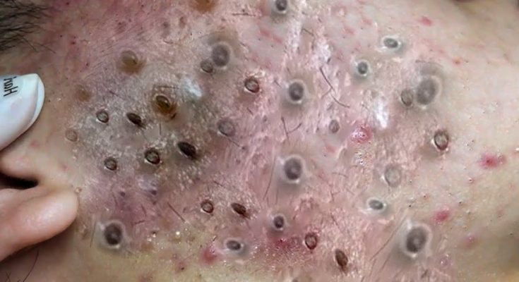 Treatments and Natural Remedies to Get Rid of Hormonal Acne