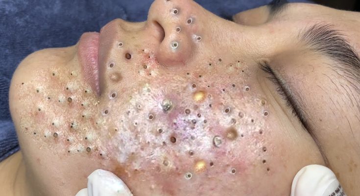 Adult Acne: I’m a Decade Past Puberty — Why Am I Still Breaking Out?