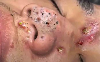 Huge Blackheads: Causes, Removal, Treatment and Prevention