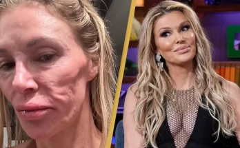 Doctor explains what 'parasite' affecting Brandi Glanville actually is after it causes her to lose five teeth and $70,000