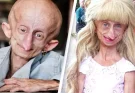 Teenage girl diagnosed with rare condition dies at 19 with the bodily age of 152 years old