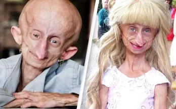 Teenage girl diagnosed with rare condition dies at 19 with the bodily age of 152 years old