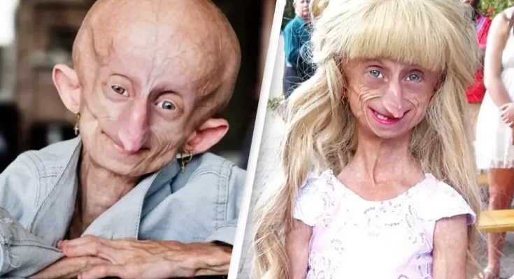 Teenage girl diagnosed with rare condition dies at 19 with the bodily age of 152 years old