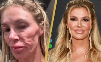 Parasite ‘having babies’ in Brandi Glanville’s face has caused her to lose 5 teeth and $70,000