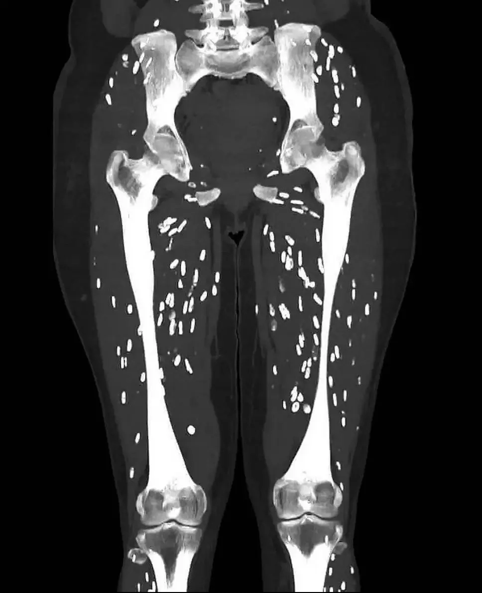 Doctor shares horrifying scan showing patient’s legs after eating undercooked pork