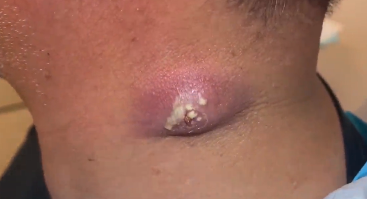 TREATMENT OF Angry Neck Abscess. Incision & Drainage. Packing removed 24 hours later. Great improvement! COMMITTED TO NOT RECURRING, NOT LEAVING SCARS