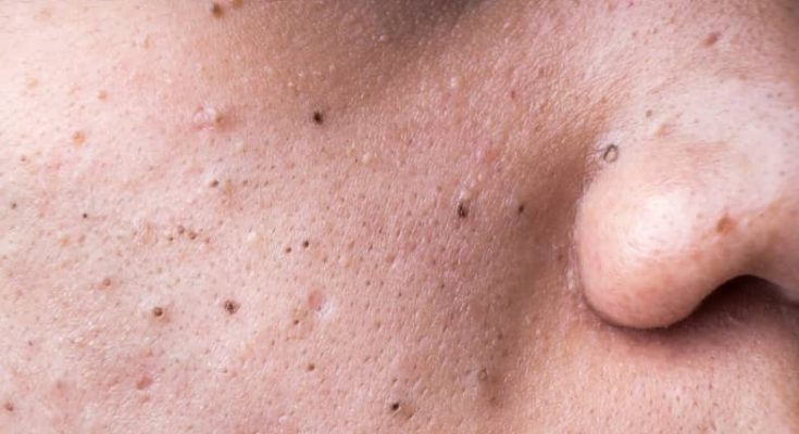 Happy new year to everyone 🎆🎆🎆 , Please watch acne with me – Acnes Treatments Mai Ngoc 💕💕💕