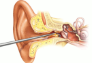 Deafness CURED After Earwax Removal