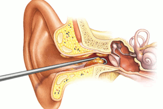 Deafness CURED After Earwax Removal