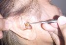 Epic Earwax Removal: Scooping Out a Huge Plug!