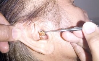 Epic Earwax Removal: Scooping Out a Huge Plug!