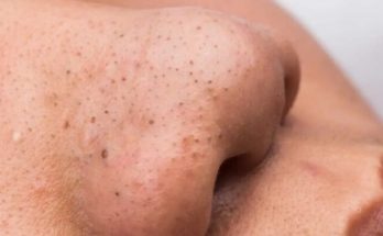 Skin Blackhead Treatment