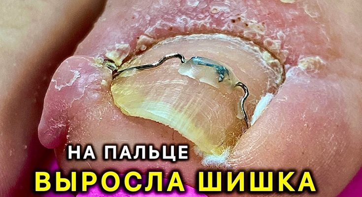 Ingrown toenail – inflamed finger!