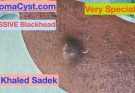 7 year Great Blackhead. Dr Khaled Sadek LipomaCyst