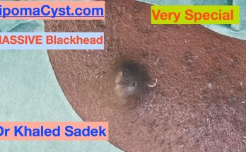 7 year Great Blackhead. Dr Khaled Sadek LipomaCyst