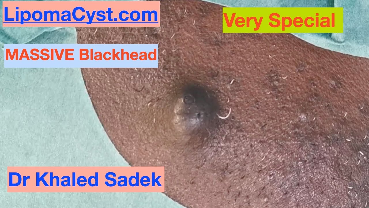 7 year Great Blackhead. Dr Khaled Sadek LipomaCyst