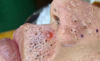 12 Ways to Get Rid of Blackheads