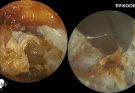 Ear Wax Removal, Dead Skin & Debris Extraction from Mastoidectomy Ear