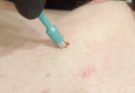 CHEST CYST!